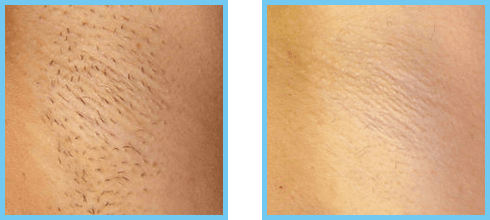 Underarms Before and After