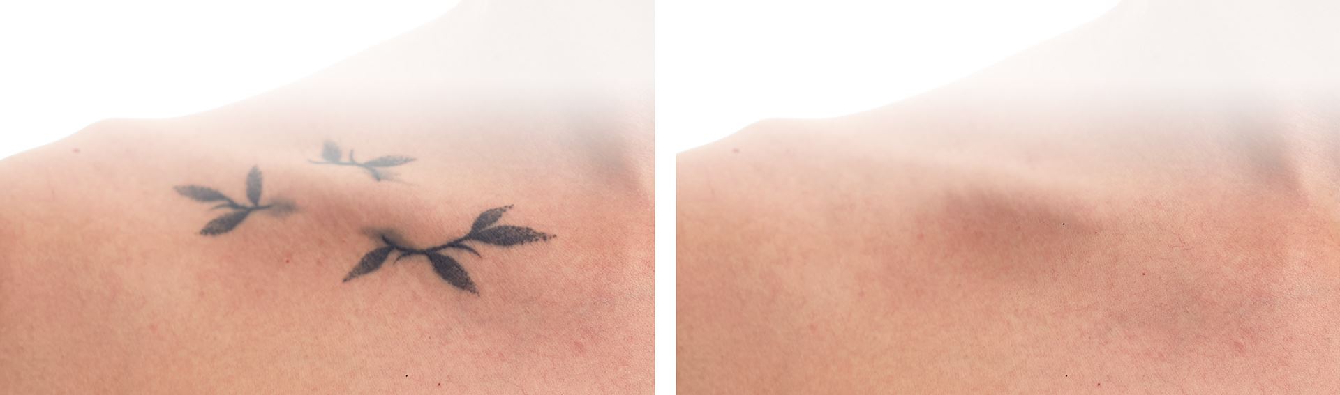 The advantages of the picosecond laser - BYE BAD TATTOO